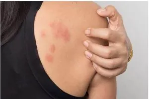 یماری های پوستی خارش دار
