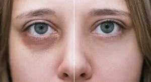 تزریق فیلر برای سیاهی دور چشم