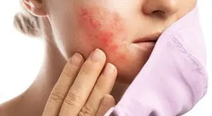 حساسیت پوستی به دارو
