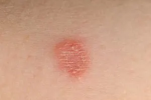 قارچ پوست صورت