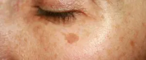 لک های ناشی از آفتاب