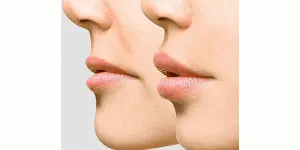 افتادگی گوشه لب ها